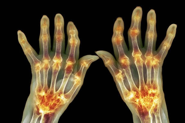 Rheumatoid Bone Disease